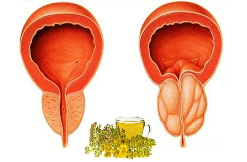 Veselīga un sāpīga prostata