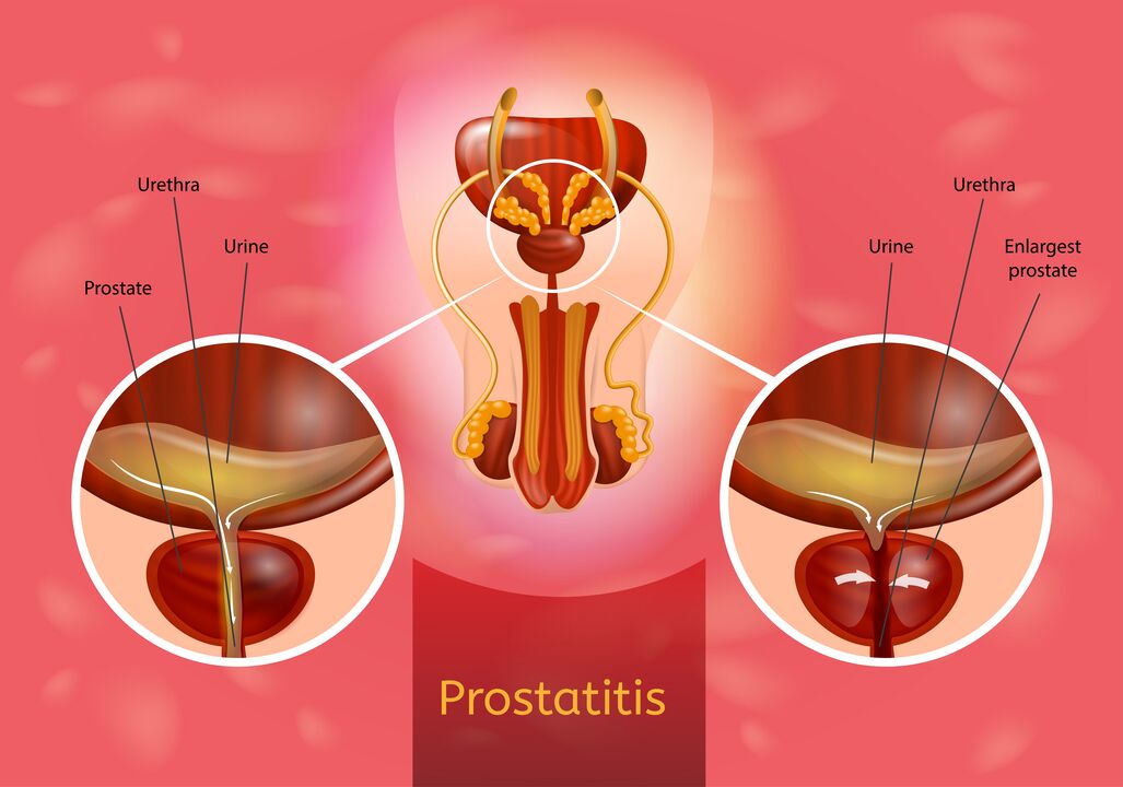Prostatas
