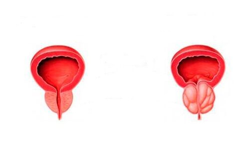 vesela un iekaisusi prostata ar prostatītu